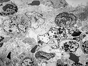 M,15y. | eosinophilic granuloma